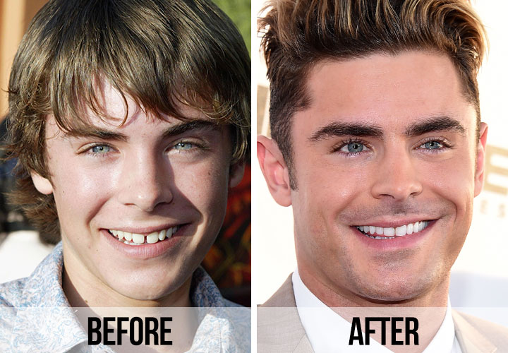 Zac Efron teeth before and after