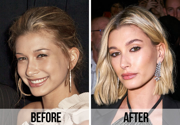 Hailey Bieber before and after side profile