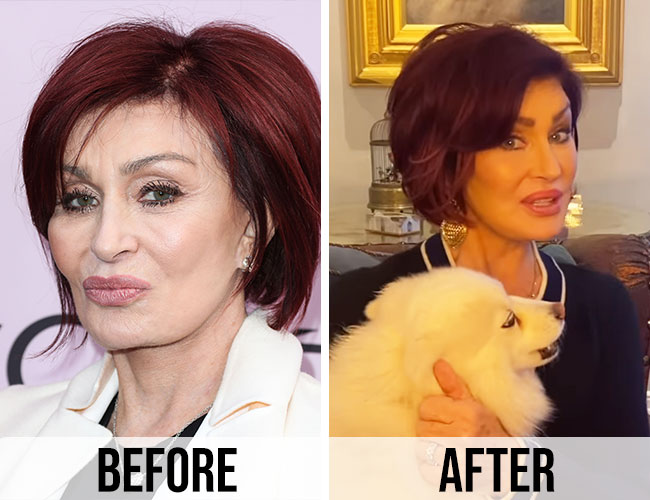 Sharon Osbourne before and after plastic surgery