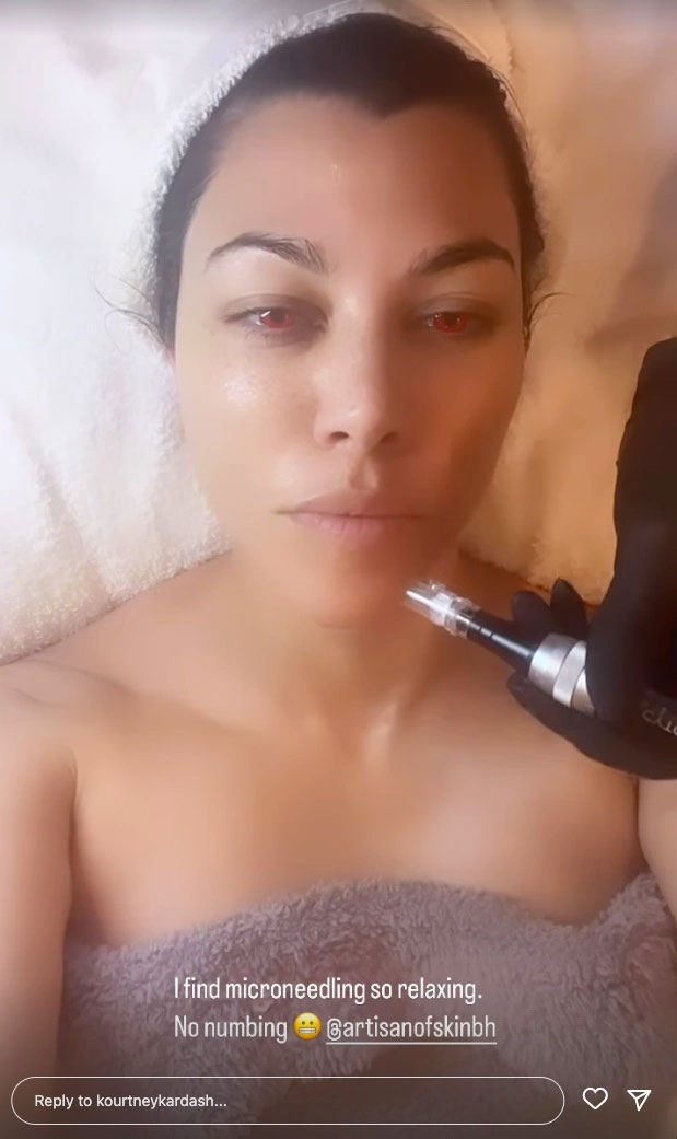 Kourtney Kardashian no makeup Instagram Story microneedling