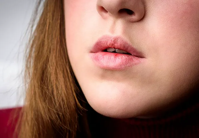 chapped-lips