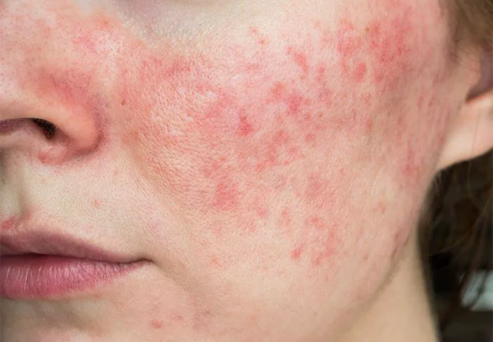 irritated skin.