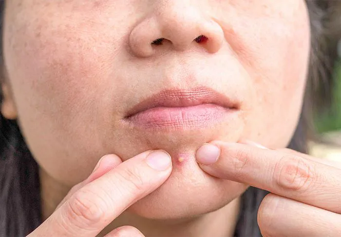 Woman popping a pimple.