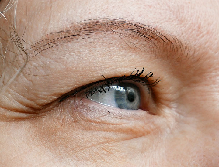 hooded-eyelid