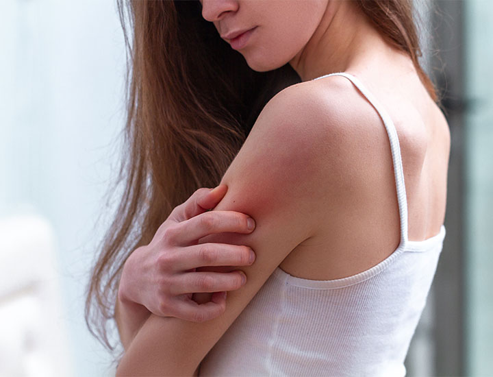 Woman with eczema.