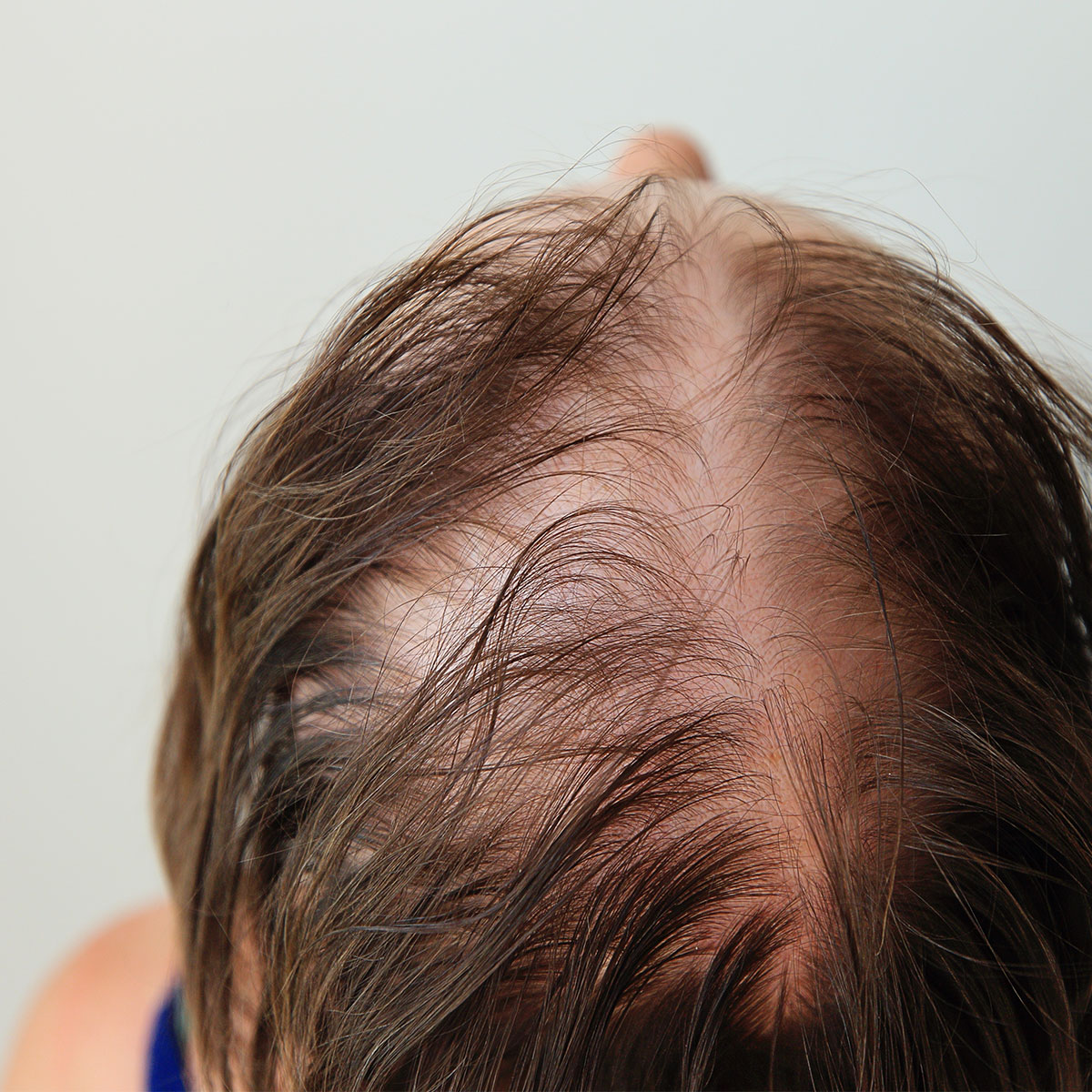 womans-patchy-scalp