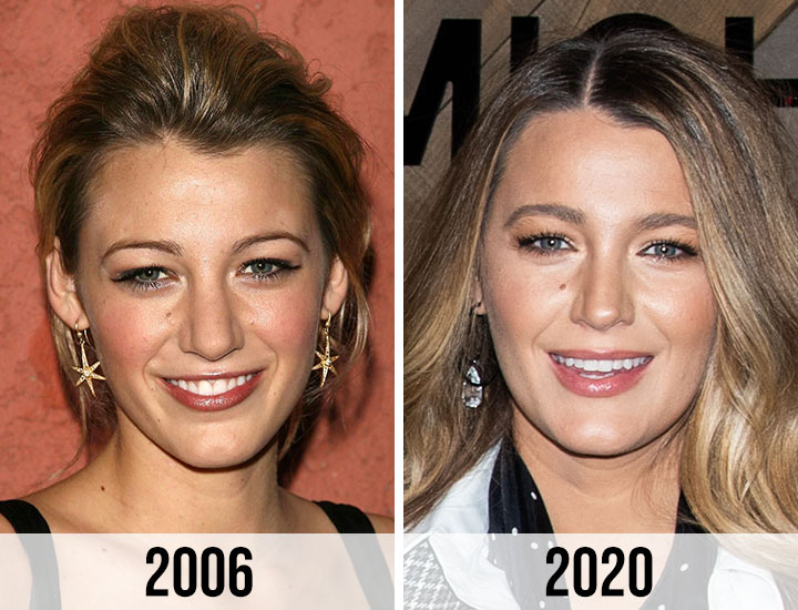 Blake Lively nose before and afterr