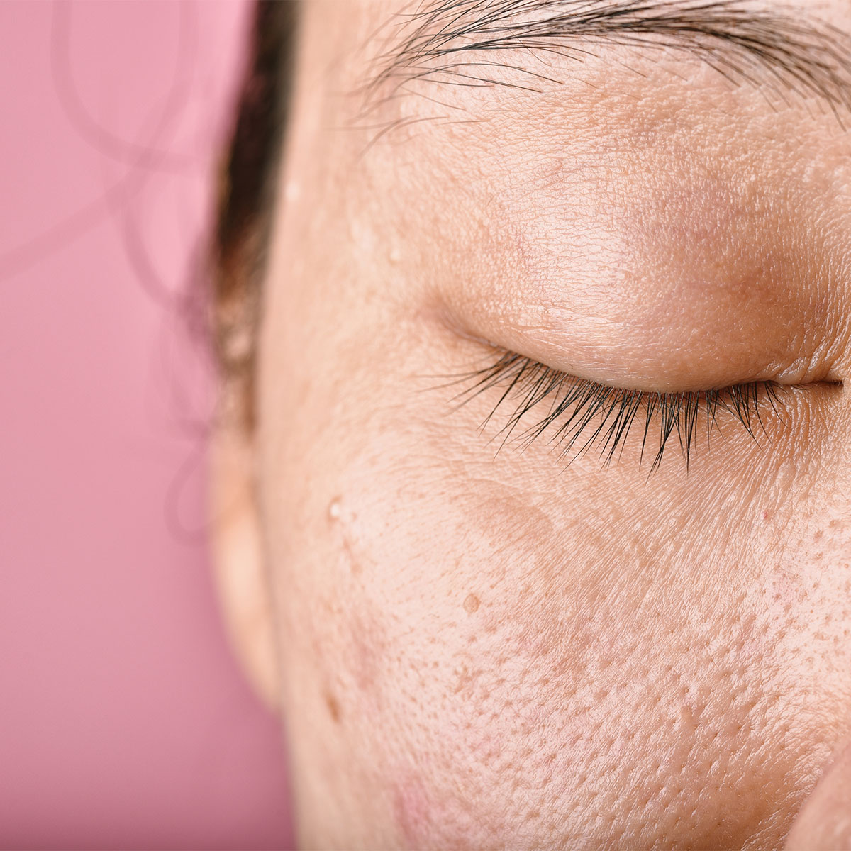 woman with dry dehydrated skin close-up