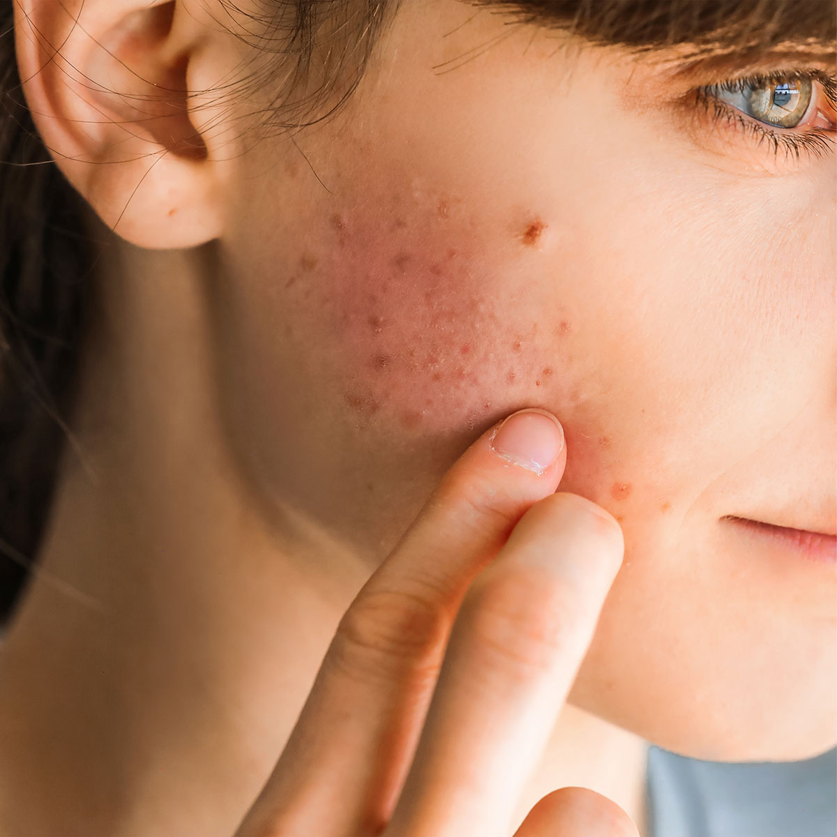 woman touching acne-inflamed scarred infected broken out red skin