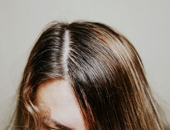 scalp-sparse-hair