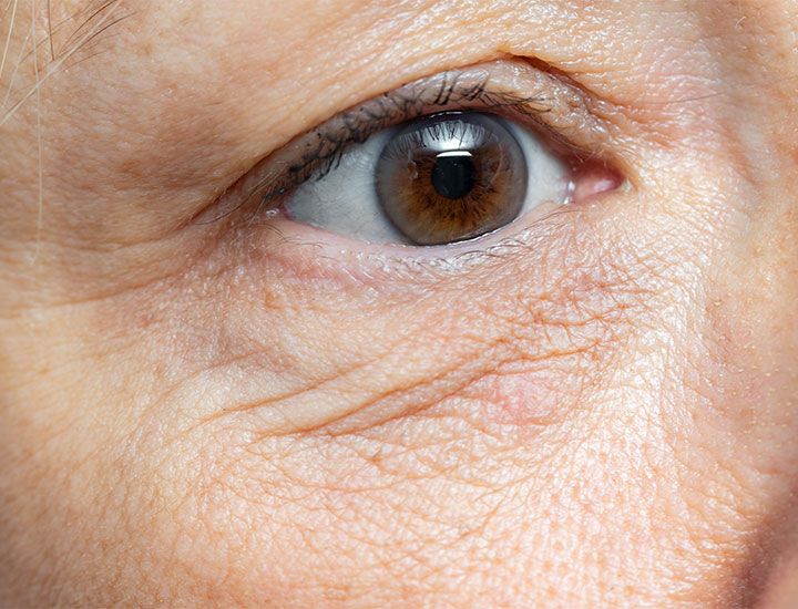 eye-wrinkles