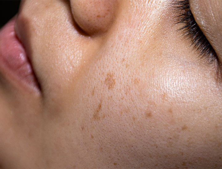 melasma-cheeks