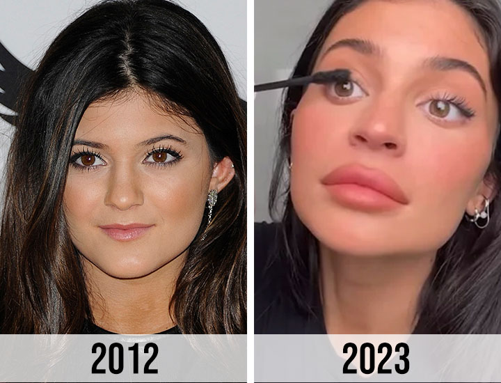 Kylie Jenner 2012 to 2023 face surgery