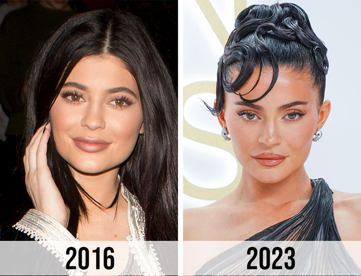 Kylie Jenner 2016 to 2023 face surgery