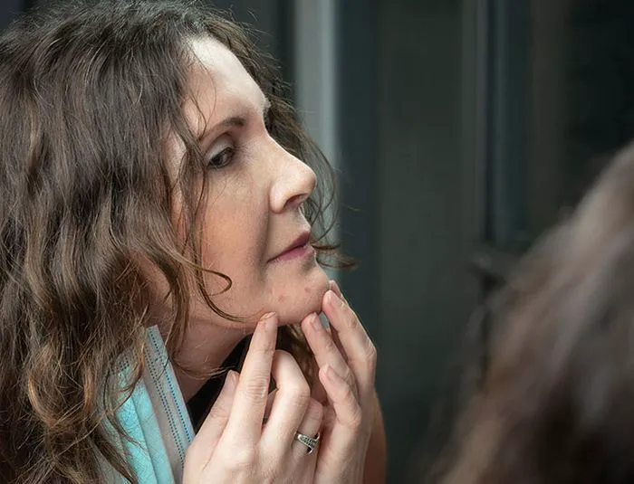 woman-acne-marks-chin