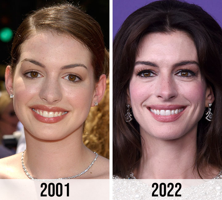 Anne Hathaway nose job speculation before and after