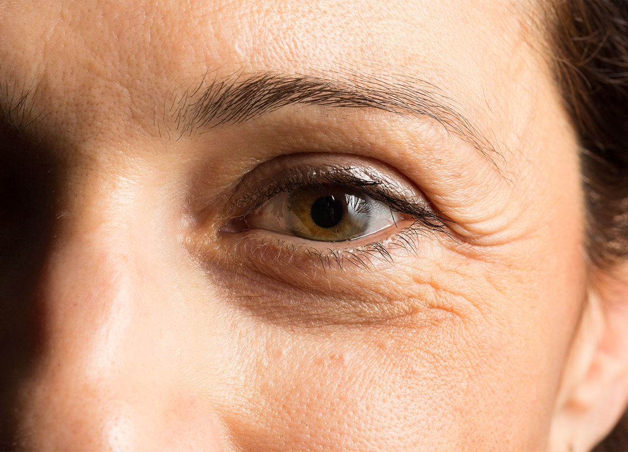 woman-wrinkles-under-eyes