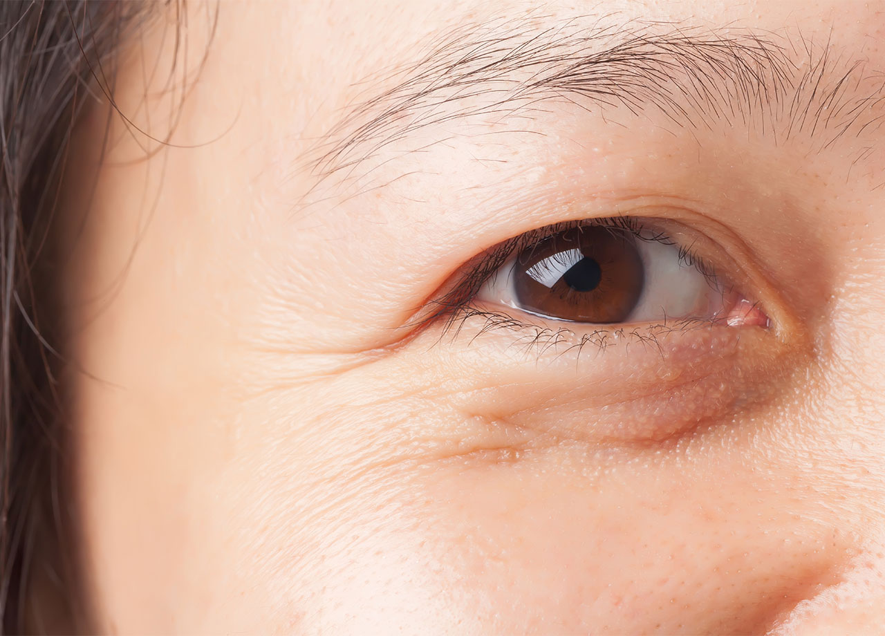 closeup-eye-wrinkles