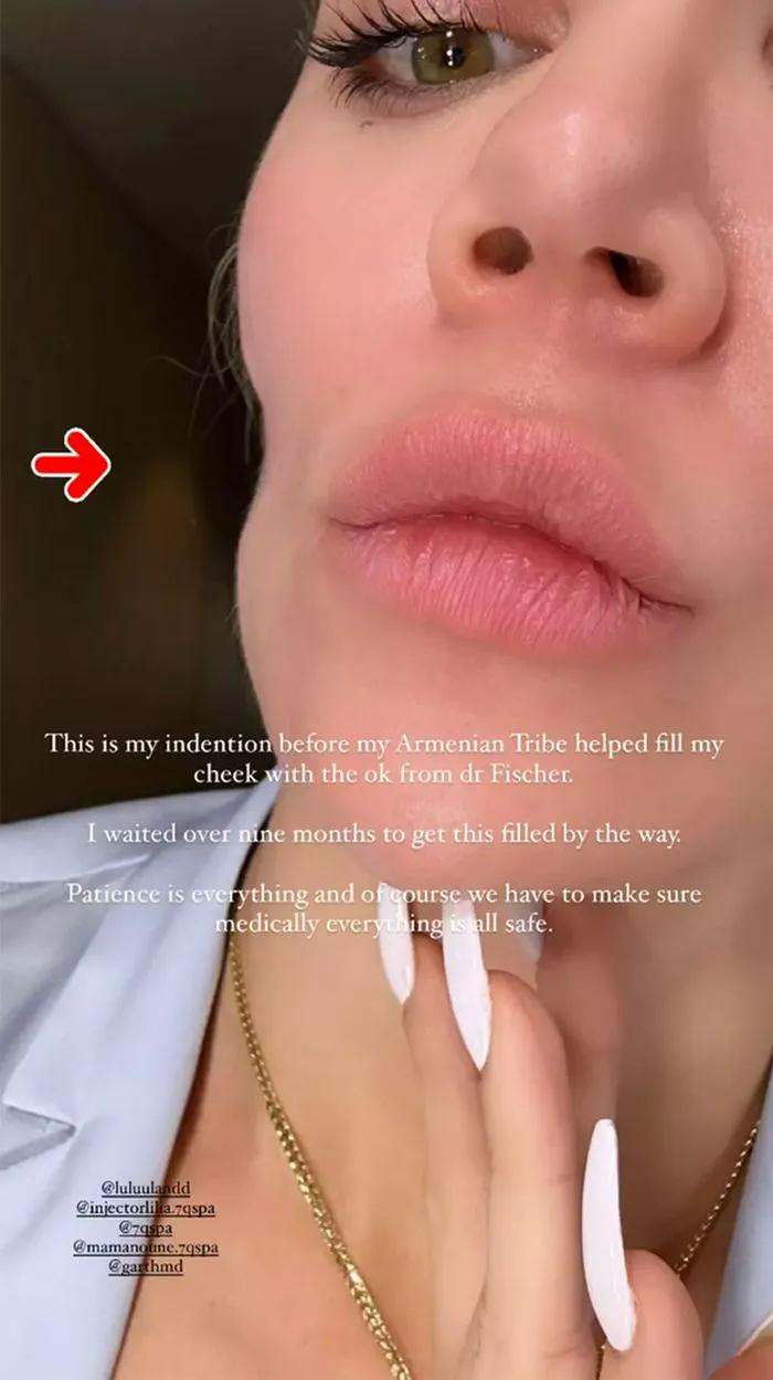 "Khloé Kardashian's cheek indentation before and after filler treatment"