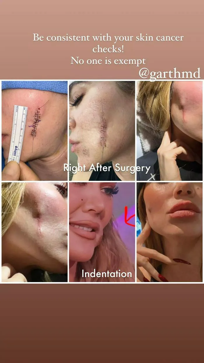 "Khloé Kardashian's Instagram story about skin cancer"