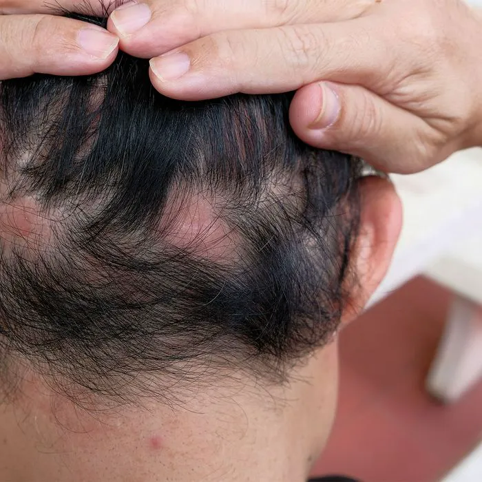 "Close-up of a woman experiencing alopecia on the back of her head"