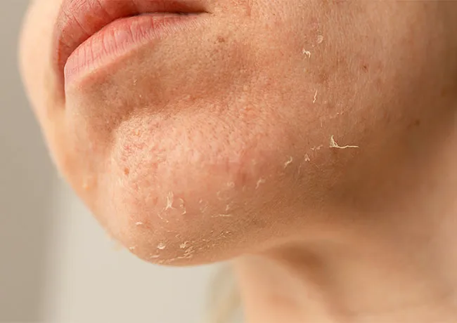 dry-skin