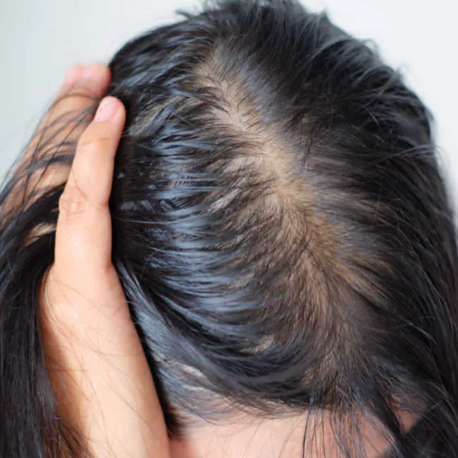 Close-up of hair loss, highlighting common concerns among women.