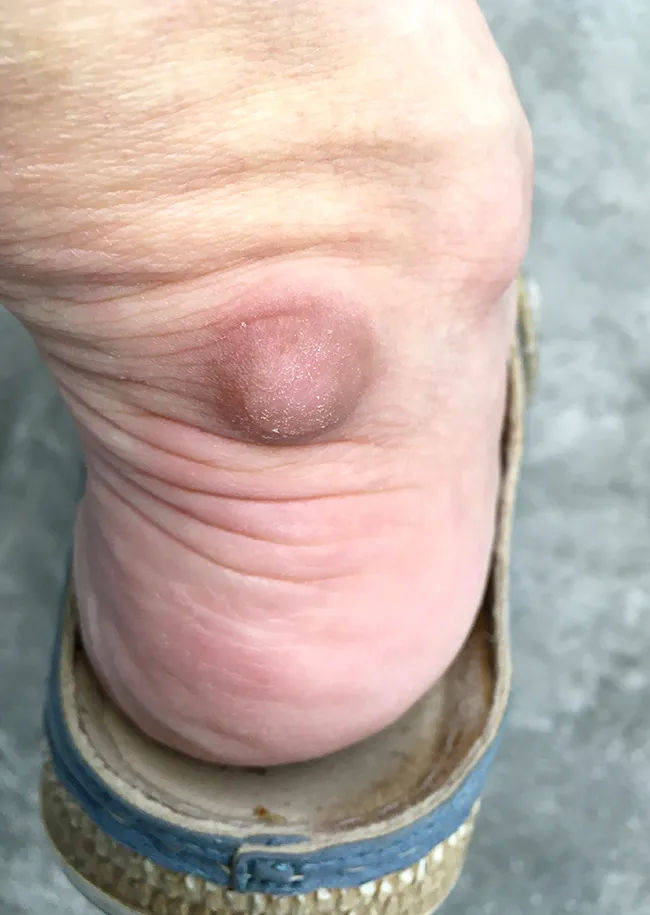 Bumps around tendons indicating xanthomas condition.