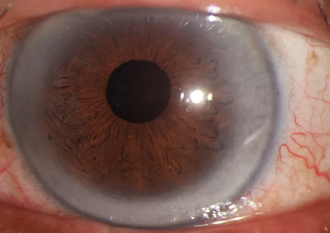Ring around iris known as corneal arcus.