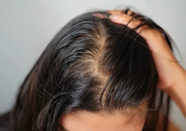 woman-showing-thinning-hair