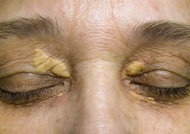 Yellow patches on eyelids indicating xanthelasmas condition.