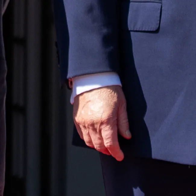 "Close-up on Donald Trump's hand showing white spots"