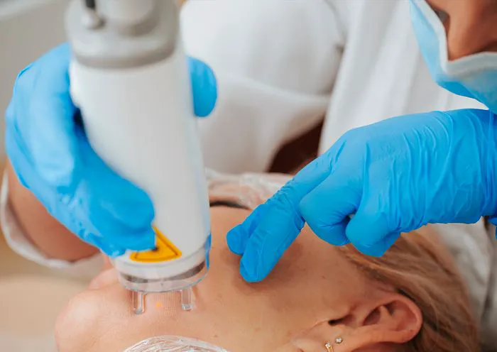 laser-resurfacing