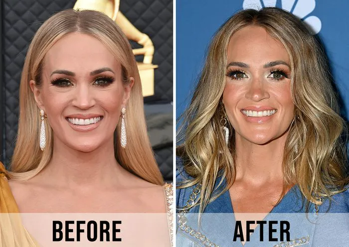 carrie underwood plastic surgery