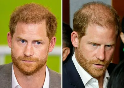 "Prince Harry with thicker hair vs thinner hair comparison"