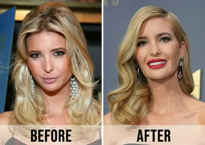 Ivanka Trump before and after skin supplement use comparison.