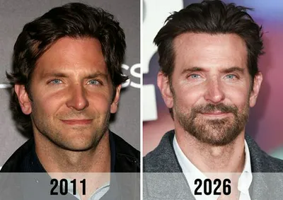 "Bradley Cooper before and after alleged surgery"